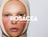 Rosácea: tudo o que precisa saber - MPL beauty